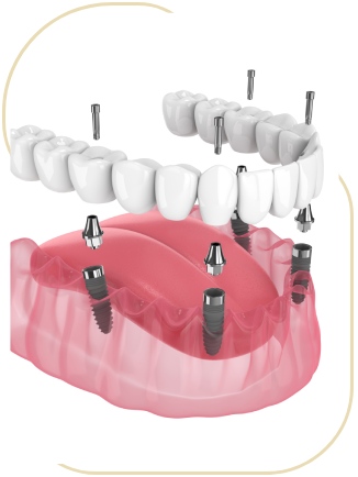 Implant-Supported Dentures (All-on-4/All-on-6) Near Me in Encino, CA