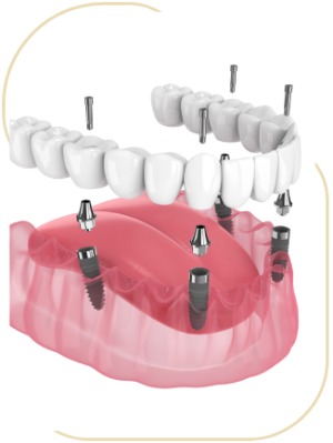 Implant-Supported Dentures (All-on-4/All-on-6) Near Me in Encino, CA