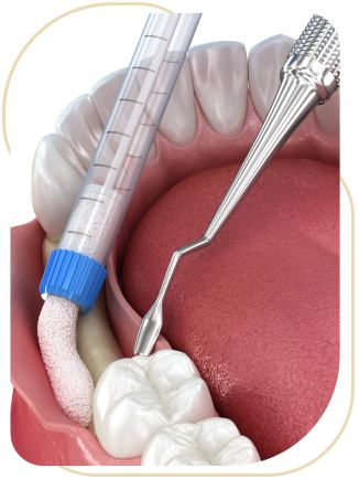 Bone Grafting Near Me in Encino, CA