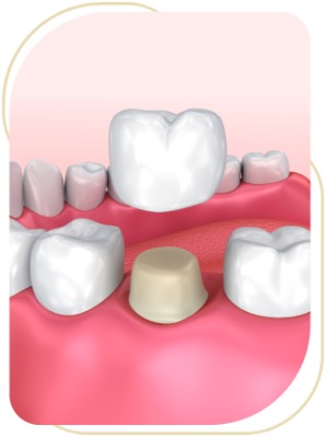 Crowns Near Me in Encino, CA