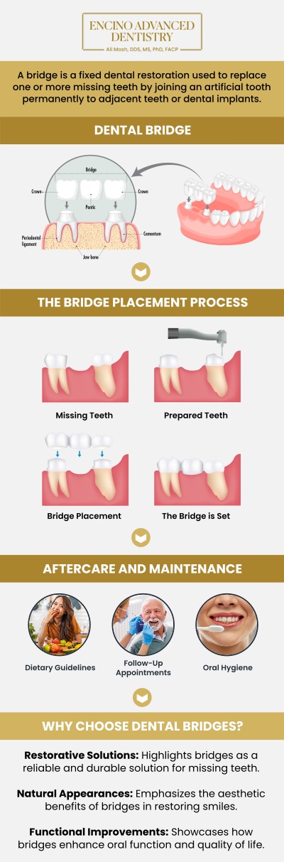Dental bridges are used to replace missing teeth, helping restore proper chewing, clear speech, and a balanced bite. They prevent surrounding teeth from shifting out of place, which can lead to jaw discomfort and further dental issues. By filling the gap, dental bridges also support facial structure and enhance smile's appearance. For personalized guidance and long-lasting results, consult Dr. Alireza Moshaverinia, D.D.S., M.S., Ph.D., F.A.C.P., for professional dental bridge care. For more information, contact us or request an appointment online. We are conveniently located at 5363 Balboa Blvd, #434 Encino, CA 91316.