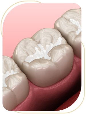 Dental Sealants Near Me in Encino, CA