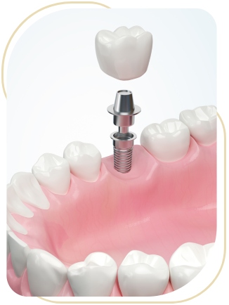 Implant Maintenance Near Me in Encino, CA