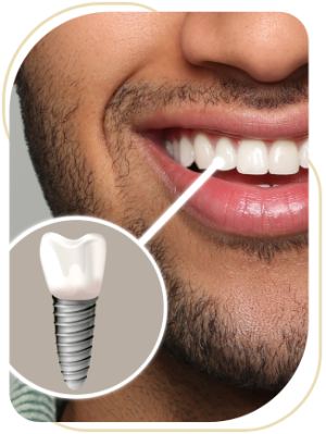 Immediate Implant Placement Near Me in Encino, CA