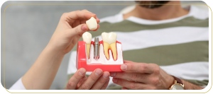 Implant-Supported Restoration Treatment Specialist Near Me in Encino, CA