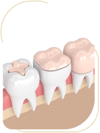 Porcelain Inlays Near Me in Encino, CA