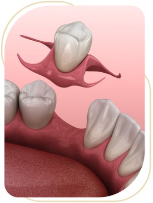 Partial Dentures Near Me in Encino, CA