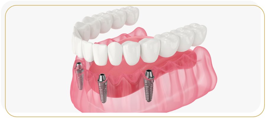 Fixed Hybrid Prostheses Treatment Specialist Near Me in Encino, CA