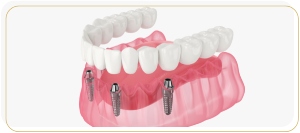 Fixed Hybrid Prostheses Treatment Specialist Near Me in Encino, CA