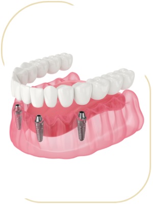 Fixed Hybrid Prostheses Near Me in Encino, CA