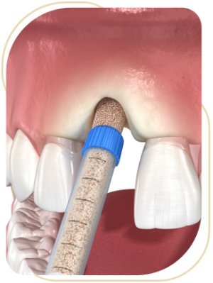 Ridge Preservation Near Me in Encino, CA