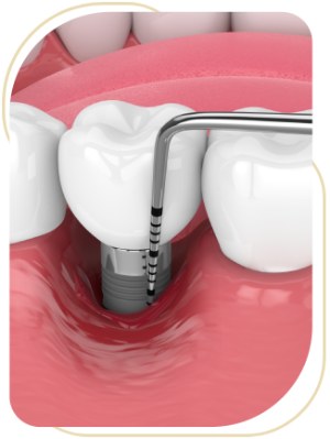 Surgical Periodontal Therapy Near Me in Encino, CA