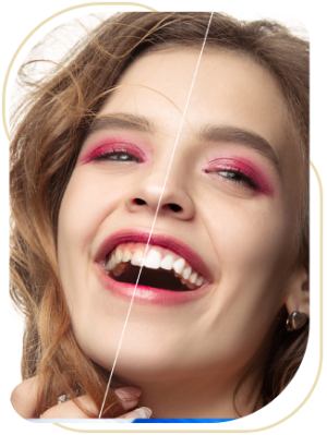 Teeth Whitening Near Me in Encino, CA