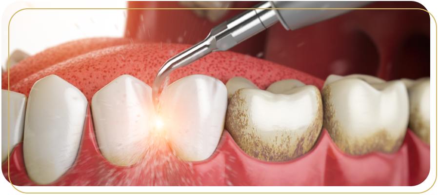 What Is Air Abrasion and How Does It Work for Tooth Treatment in Encino, CA