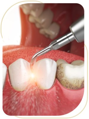 Air Abrasion Near Me in Encino, CA