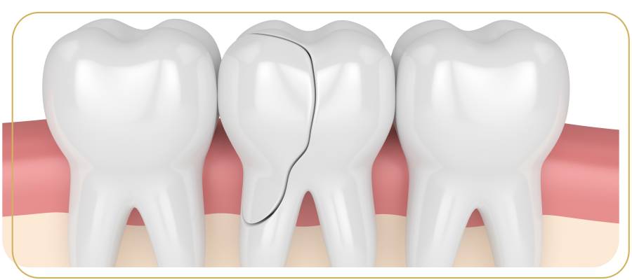 How to Treat a Cracked Tooth |  Encino Advanced Dentistry in Encino CA