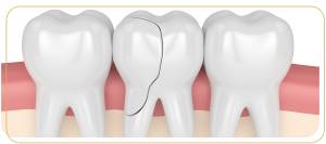 How to Treat a Cracked Tooth |  Encino Advanced Dentistry in Encino CA