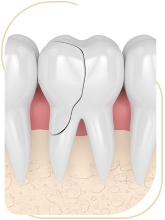 Cracked Tooth Clinic in Encino, CA