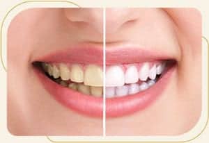 Teeth Whitening Near Me in Encino, CA