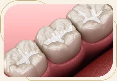 Dental Sealants Near Me in Encino, CA