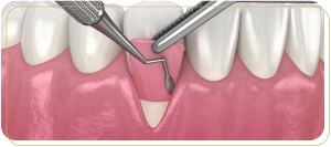 What Are the Benefits of Gum Grafting for Restoring Gum Health Near Me in Encino, CA