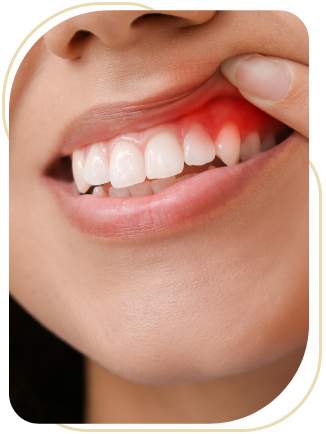 Gum Recession Treatment in Encino, CA