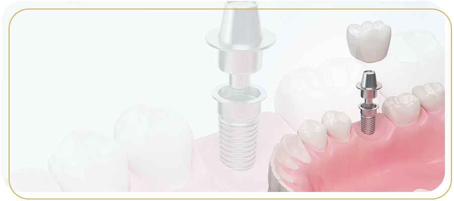 What Are the Common Issues That Implant Maintenance Helps Prevent Near Me in Encino, CA?