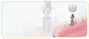 What Are the Common Issues That Implant Maintenance Helps Prevent Near Me in Encino, CA?
