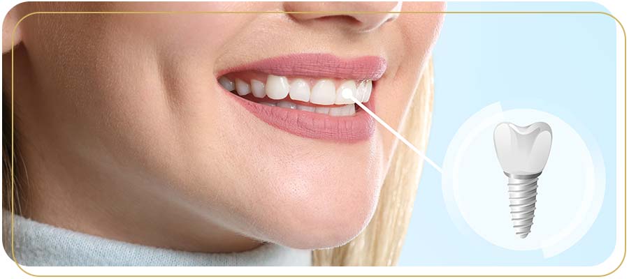 How Can Peri-implantitis Be Managed to Protect Your Dental Implants Near Me in Encino, CA?