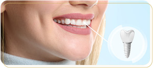 How Can Peri-implantitis Be Managed to Protect Your Dental Implants Near Me in Encino, CA?