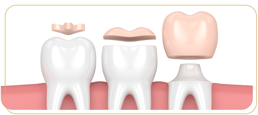 Porcelain Onlays Treatment Specialist Near Me in Encino, CA