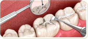 What Are the Benefits of Sealing Out Tooth Decay for Long-Term Oral Health Near Me in Encino, CA