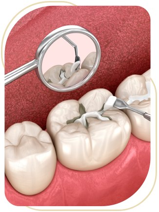 Sealing Out Tooth Decay Near Me in Encino, CA