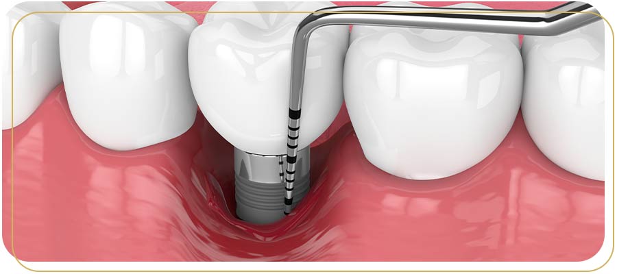 Surgical Periodontal Therapy Near Me in Encino, CA