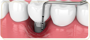 Surgical Periodontal Therapy Near Me in Encino, CA