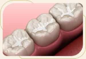 Dental Sealants Near Me in Encino, CA