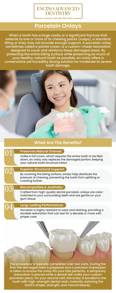 Porcelain onlays offer a superior, conservative alternative to full dental crowns by precisely restoring teeth that have structural damage extending over one or more cusps. This advanced treatment effectively preserves your healthy tooth structure while reinforcing its integrity, ensuring a long-lasting and beautiful restoration for a functional smile. Visit Dr. Alireza Moshaverinia, D.D.S., M.S., Ph.D., F.A.C.P. at Encino Advanced Dentistry. For more information, contact us or request an appointment online. We are conveniently located at 5363 Balboa Blvd, #434 Encino, CA 91316.