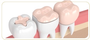 What Is the Difference Between a Dental Onlay and a Dental Inlay? | Encino Advanced Dentistry in Encino, CA.
