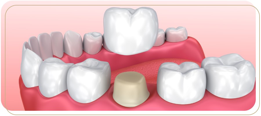 Inlays, Onlays, or Crowns Encino CA : Which Dental Restoration Do You Need?