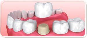 Inlays, Onlays, or Crowns Encino CA : Which Dental Restoration Do You Need?
